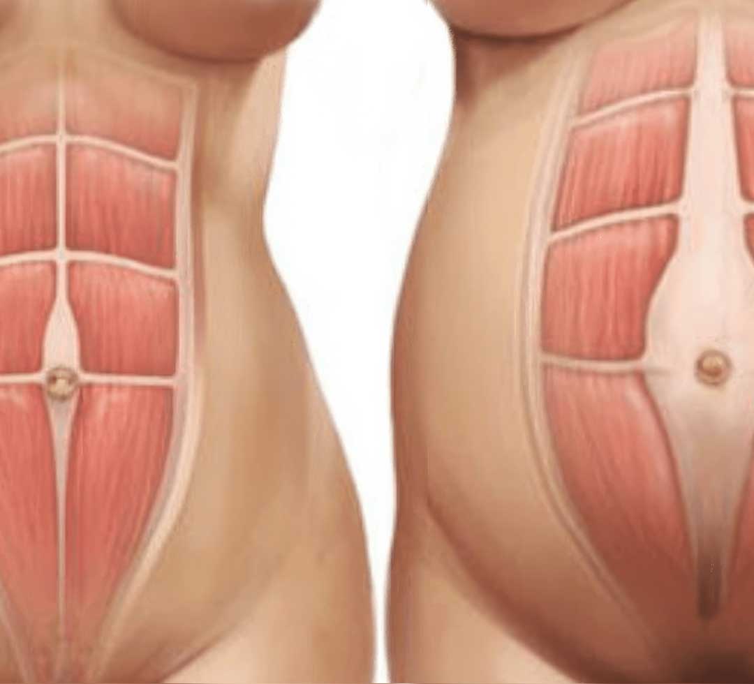 After Childbirth, Diastasis Recti Abdominis (DRA) Will Only Close Partially On Its Own