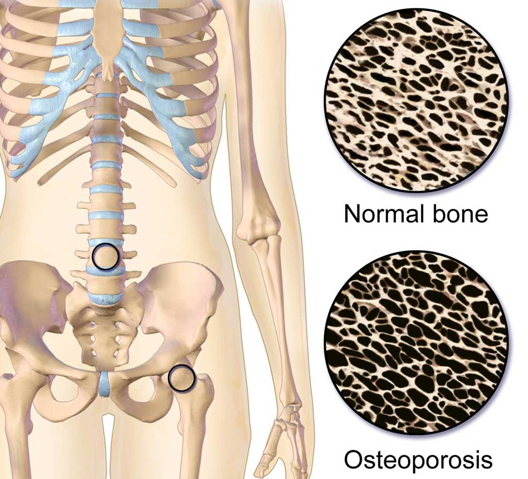 Should You Be Concerned About Pregnancy-associated Osteoporosis (PAO)?